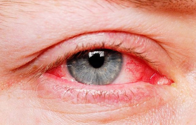 bloodshot eyes: how to reduce eye redness| men's health