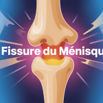 illustration médicale du genou avec fissure du ménisque
